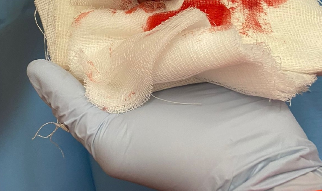 Gli scoppia il petardo in mano: uomo perde un dito