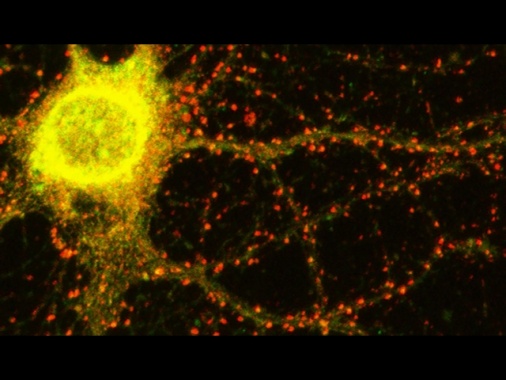 Alzheimer, italiani scoprono nuovo gene che causa malattia