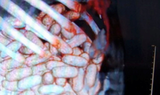 Nella foto, una radiografia addominale di un ovulatore di stupefacenti arrestato dalla Finanza dello scalo di Malpensa