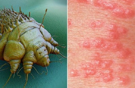 Caso di scabbia in una scuola di Nerviano